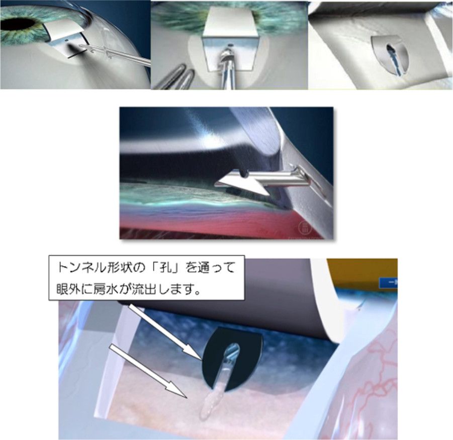 緑内障フィルトレーションデバイス