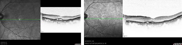 加齢黄斑変性と診断された患者さんの初診時の網膜の断層像と蛍光眼底造影写真(右)