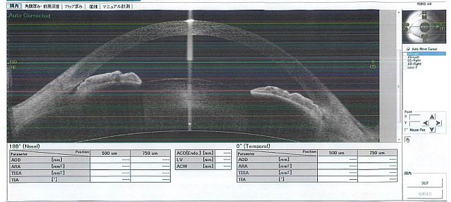 急性緑内障発作の方の隅角写真