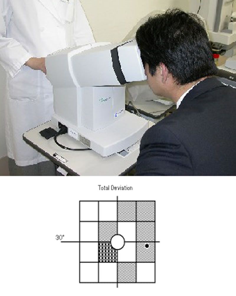 FDT視野